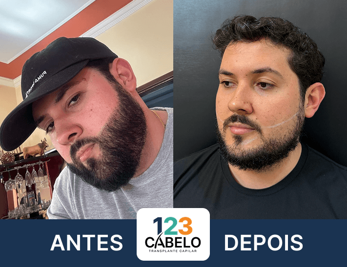 case-de-sucesso-123-cabelos-transplante-capilar-em-sp-01