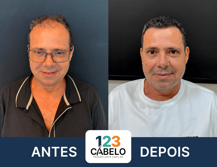 case-de-sucesso-123-cabelos-transplante-capilar-em-sp-02