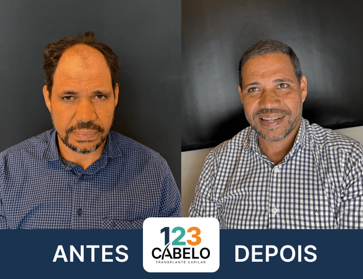 case-de-sucesso-123-cabelos-transplante-capilar-em-sp-03