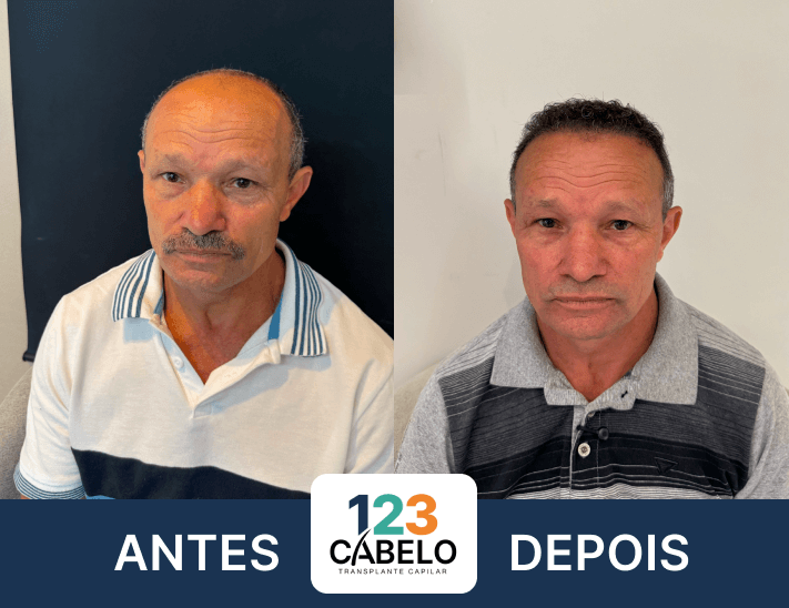 case-de-sucesso-123-cabelos-transplante-capilar-em-sp-04
