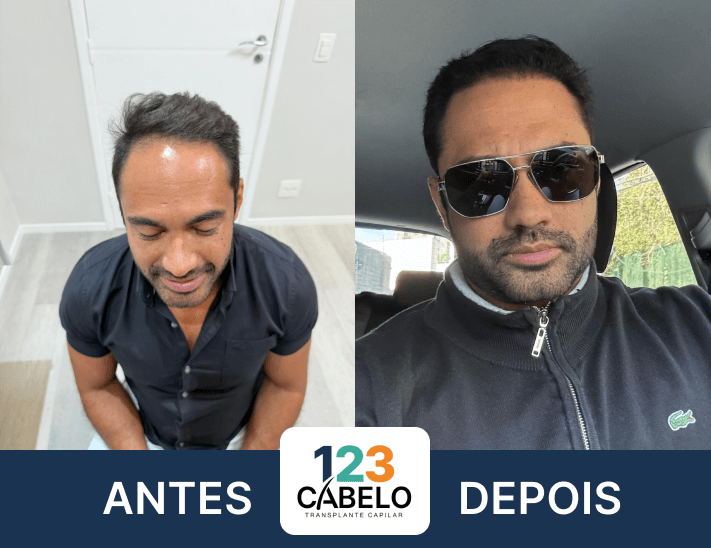 case-de-sucesso-123-cabelos-transplante-capilar-em-sp-05